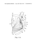 MINIMALLY INVASIVE LEVATOR AVULSION REPAIR diagram and image