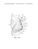 MINIMALLY INVASIVE LEVATOR AVULSION REPAIR diagram and image