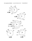 DEVICE WITH ACTIVE VALVE TO BLOCK EMESIS AND REFLUX BLOCKAGE DEVICE AND     ASSOCIATED SYSTEM AND METHOD diagram and image