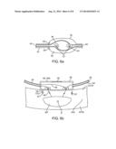 Apparatus and Method for the Detection and Treatment of Atrial     Fibrillation diagram and image