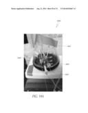 ADJUSTABLE CONNECTOR, IMPROVED FLUID FLOW AND REDUCED CLOTTING RISK diagram and image