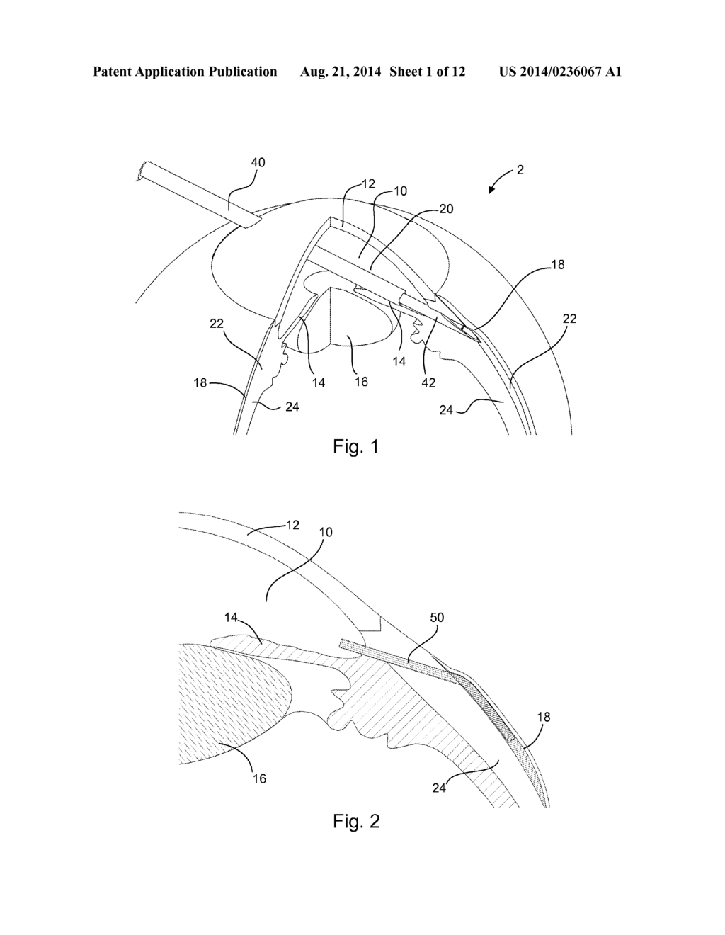 ADJUSTABLE GLAUCOMA IMPLANT - diagram, schematic, and image 02