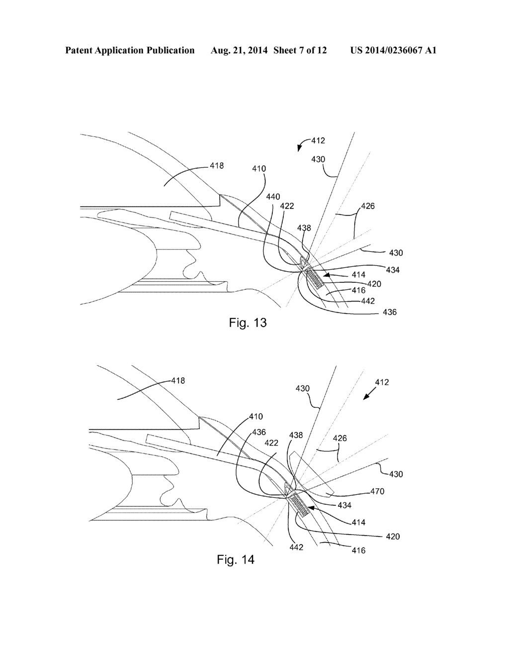 ADJUSTABLE GLAUCOMA IMPLANT - diagram, schematic, and image 08