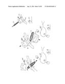 PNEUMOPERITONEUM DEVICE diagram and image