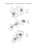 PNEUMOPERITONEUM DEVICE diagram and image