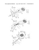 PNEUMOPERITONEUM DEVICE diagram and image