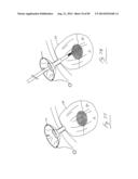 PNEUMOPERITONEUM DEVICE diagram and image