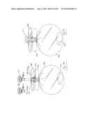 PNEUMOPERITONEUM DEVICE diagram and image