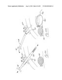 PNEUMOPERITONEUM DEVICE diagram and image