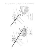 PNEUMOPERITONEUM DEVICE diagram and image