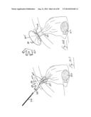 PNEUMOPERITONEUM DEVICE diagram and image