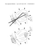 PNEUMOPERITONEUM DEVICE diagram and image