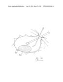 PNEUMOPERITONEUM DEVICE diagram and image