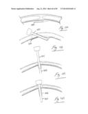 PNEUMOPERITONEUM DEVICE diagram and image