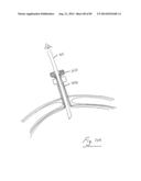 PNEUMOPERITONEUM DEVICE diagram and image