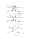 PNEUMOPERITONEUM DEVICE diagram and image