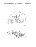 METHODFOR THE IMPLANTATION OF ACTIVE FIXATION MEDICAL LEADS diagram and image