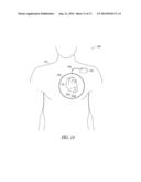 WIRELESS TISSUE ELECTROSTIMULATION diagram and image