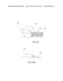 METHODS AND DEVICES FOR DEPLOYMENT INTO A LUMEN diagram and image