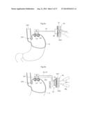 DEVICE FOR TREATING OBESITY diagram and image