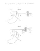 DEVICE FOR TREATING OBESITY diagram and image