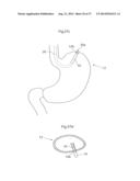 DEVICE FOR TREATING OBESITY diagram and image