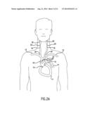 Anti-Embolic Device and Method diagram and image