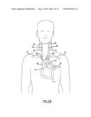 Anti-Embolic Device and Method diagram and image