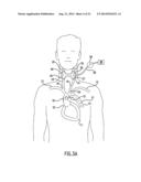 Anti-Embolic Device and Method diagram and image