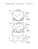 Anti-Embolic Device and Method diagram and image