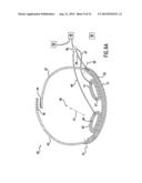 Anti-Embolic Device and Method diagram and image