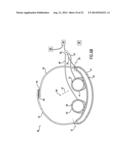 Anti-Embolic Device and Method diagram and image