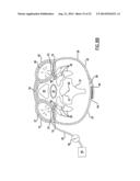 Anti-Embolic Device and Method diagram and image