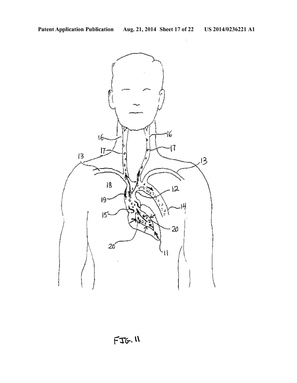 Anti-Embolic Device and Method - diagram, schematic, and image 18