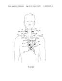 Anti-Embolic Device and Method diagram and image