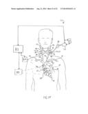 Anti-Embolic Device and Method diagram and image