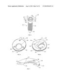 SPINAL PLATE WITH COMPRESSION LOCKING diagram and image