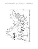 METHOD FOR IMPLANTING A ROD IMPLANT ALONG A SPINE OF A PATIENT diagram and image