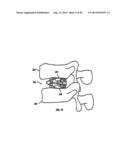 Expandable Fusion Device and Method Installation Thereof diagram and image