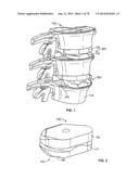 Systems and Apparatuses for Inserting an Implant in Intervertebral Space diagram and image