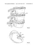 Systems and Apparatuses for Inserting an Implant in Intervertebral Space diagram and image