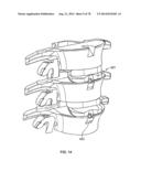 Systems and Apparatuses for Inserting an Implant in Intervertebral Space diagram and image