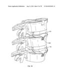 Systems and Apparatuses for Inserting an Implant in Intervertebral Space diagram and image