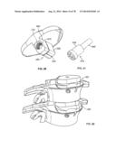 Systems and Apparatuses for Inserting an Implant in Intervertebral Space diagram and image