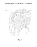 SHOULDER INTER-SPACER COMPONENT AND SURGICAL METHOD OF IMPLANTATION diagram and image