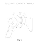 SHOULDER INTER-SPACER COMPONENT AND SURGICAL METHOD OF IMPLANTATION diagram and image