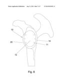 SHOULDER INTER-SPACER COMPONENT AND SURGICAL METHOD OF IMPLANTATION diagram and image