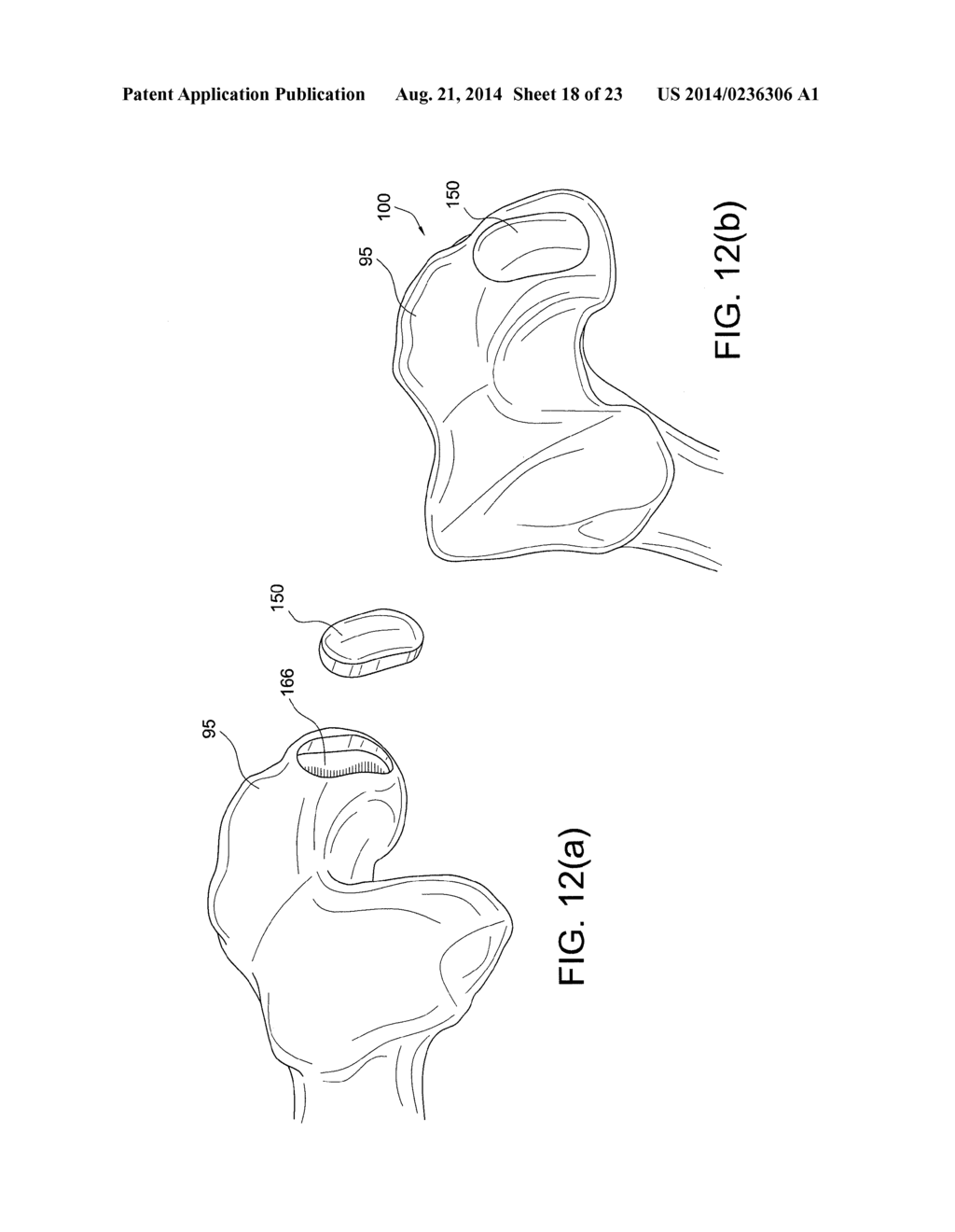 METHODS AND INSTRUMENTS FOR FORMING NON-CIRCULAR CARTILAGE GRAFTS - diagram, schematic, and image 19