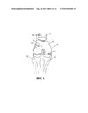 Devices and methods for treating defects in the tissue of a living being diagram and image