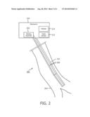 SHAPE SENSING ASSISTED MEDICAL PROCEDURE diagram and image